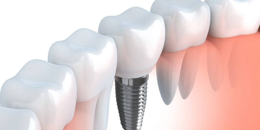 Dental Implants to help restore your simle