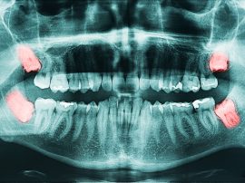 X-ray of impacted wisdom teeth that require removal in Brisbane