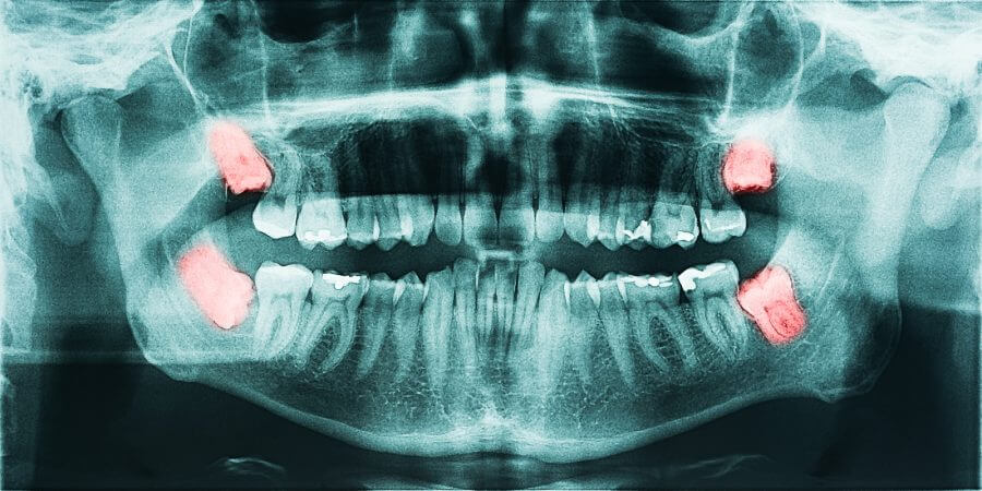 X-ray of impacted wisdom teeth that require removal in Brisbane